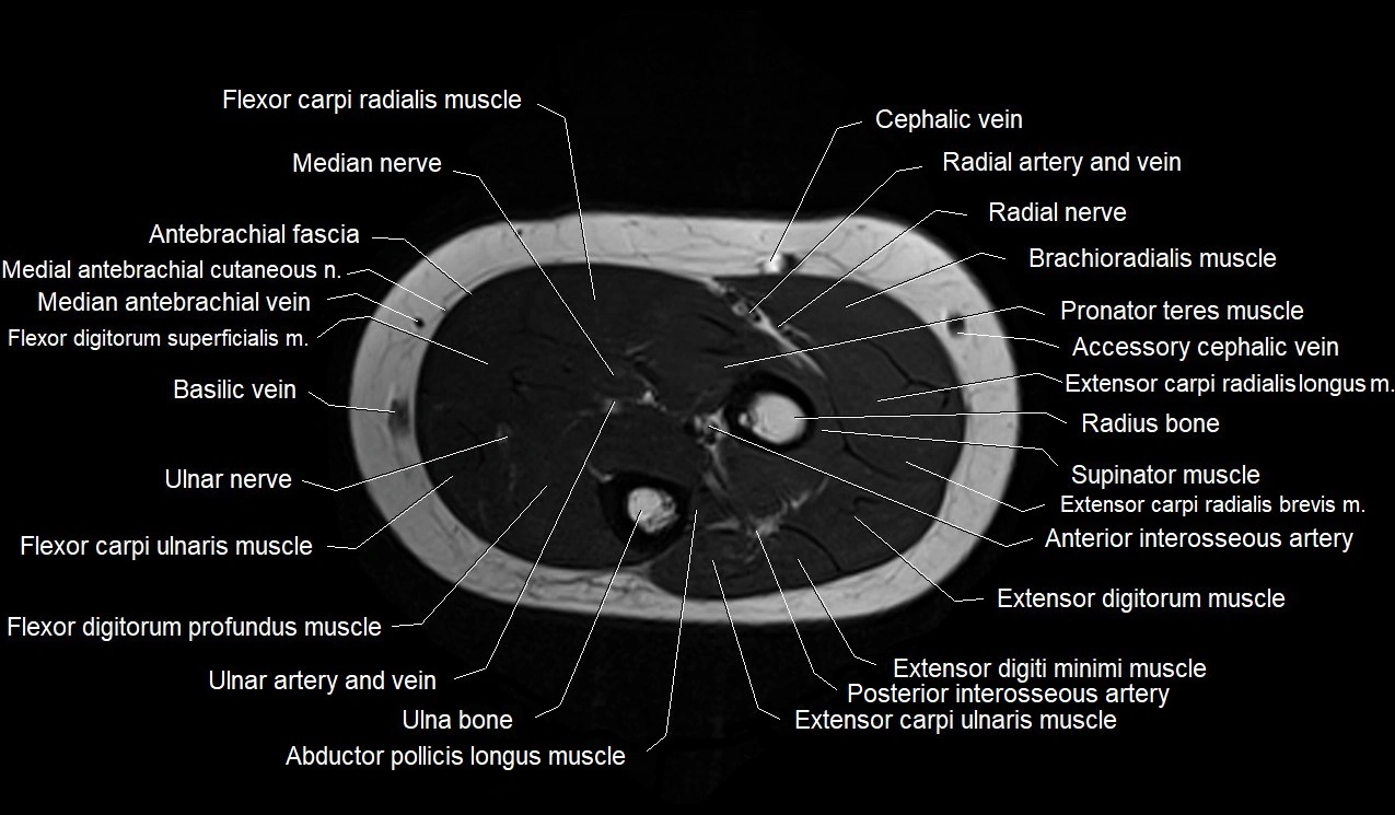 MRI 3T forearm axial cross sectional anatomy image 17.webp